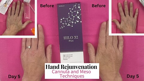 Hand Rejuvenation with HiLo 32 Plus - Cannula & Meso