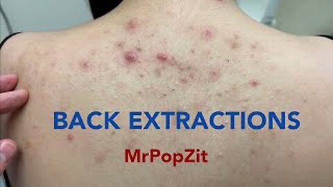 Tons of blackheads on the back. Acne extractions.