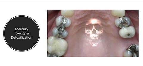 Mercury Detoxification (Dental Fillings)