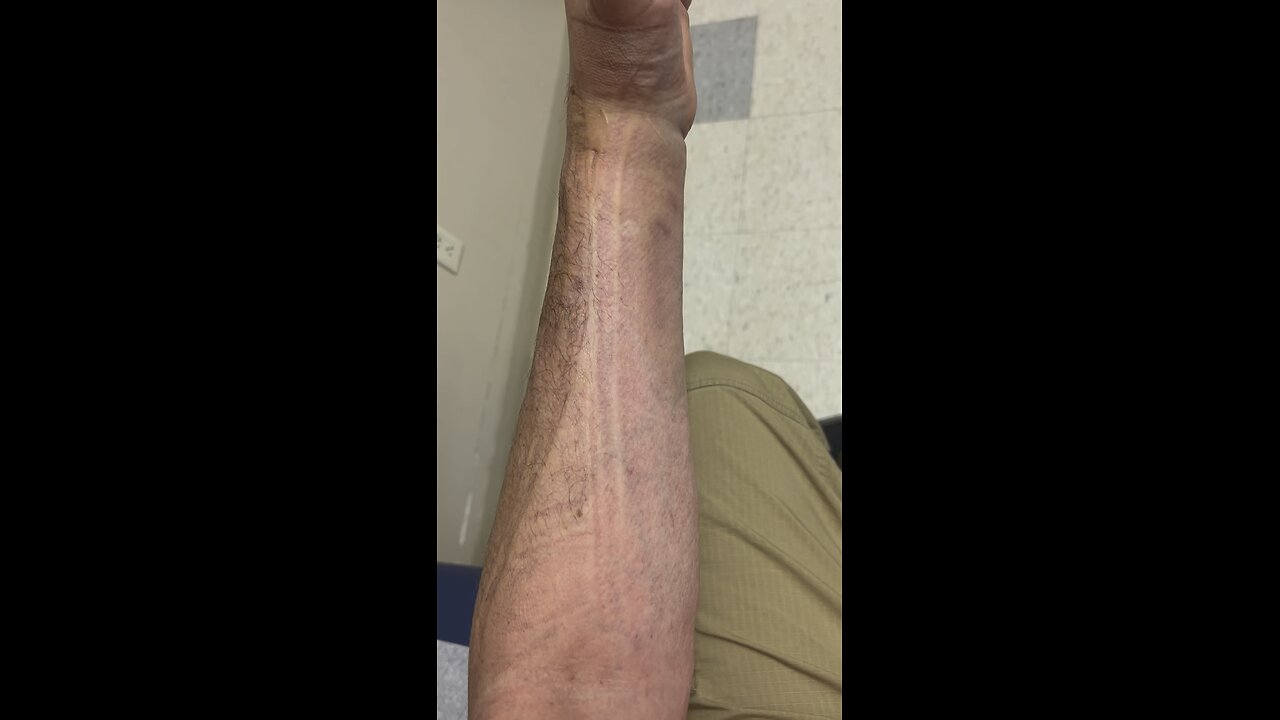 Broken wrist from skateboarding - #skateboardingisfun