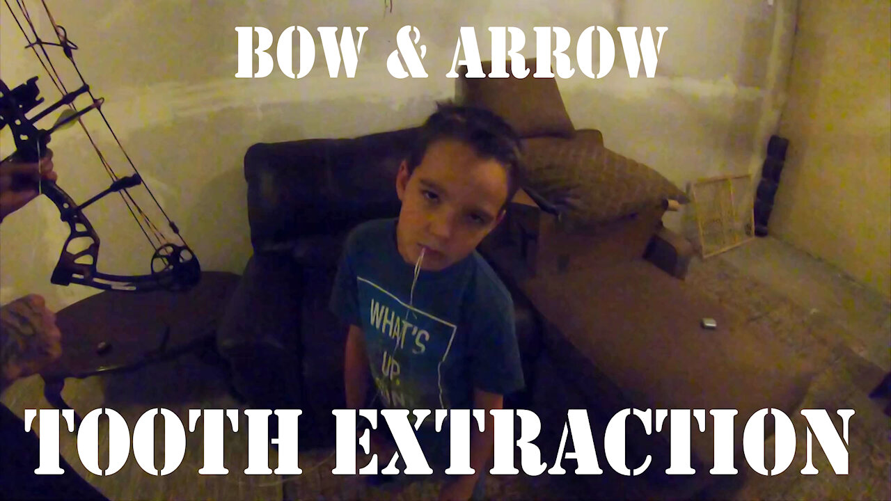 Bow and Arrow Tooth Extraction