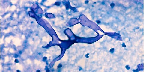 Killer Black Fungus Disease Detected in South America! Associated with COVID!