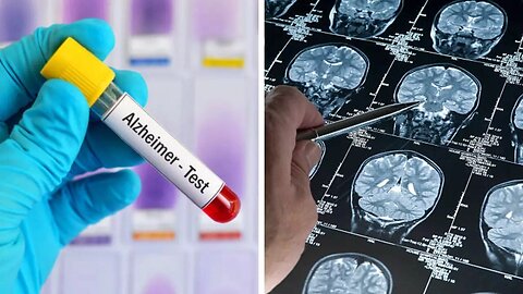 New blood tests could detect Alzheimer’s disease more accurately