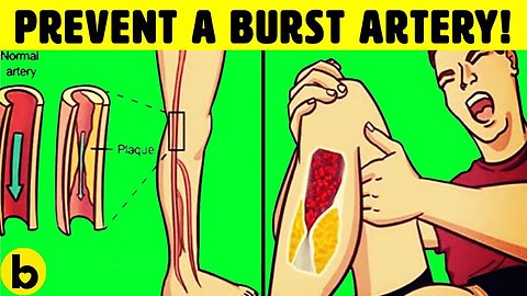 Natural Blood Thinners And How To Prevent Blood Clots
