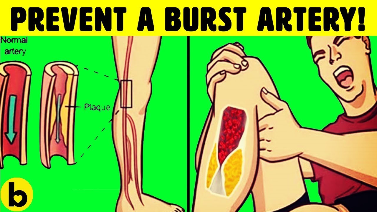 Natural Blood Thinners And How To Prevent Blood Clots