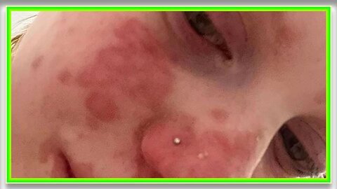 22-year-old woman horrifically scarred by VAXX poison induced Stevens-Johnson Syndrome