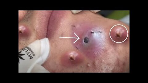 blackhead removal and Relaxing Video