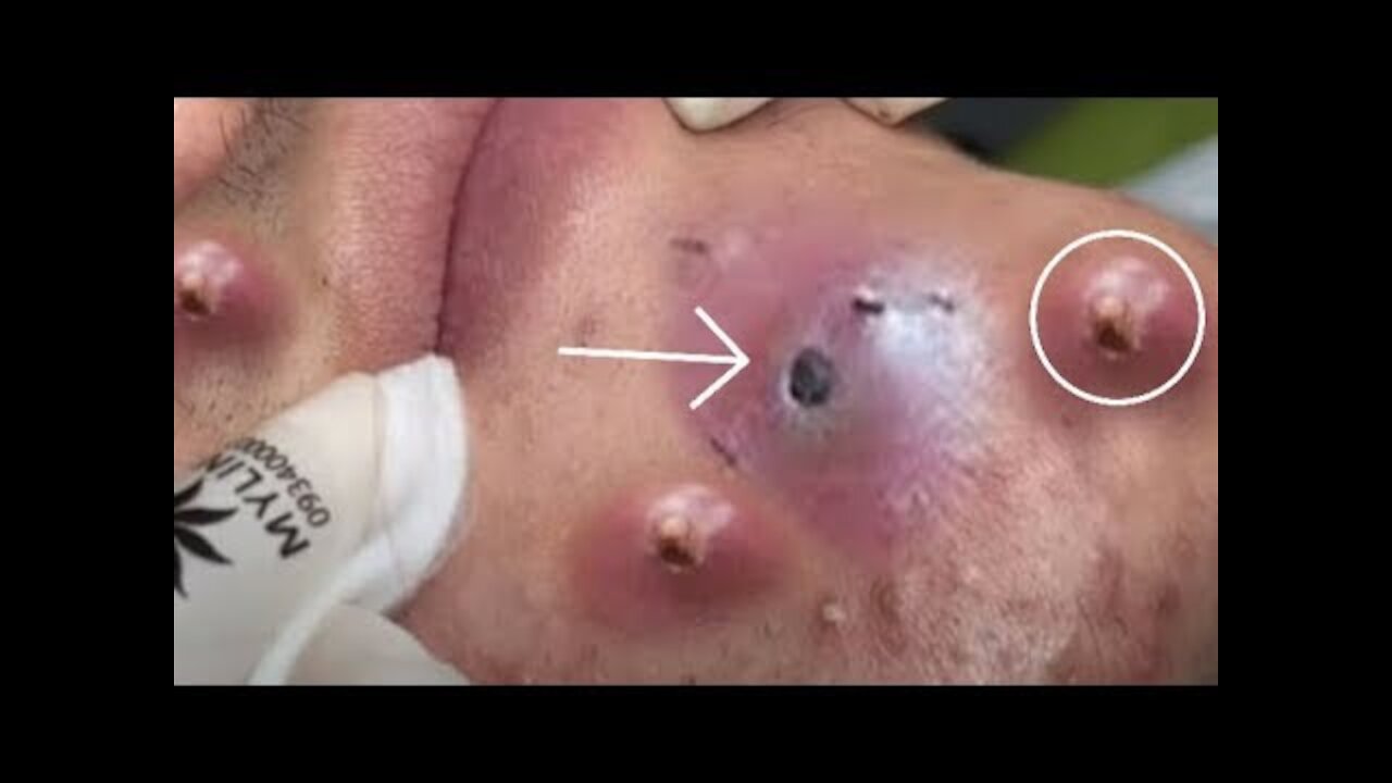 blackhead removal and Relaxing Video