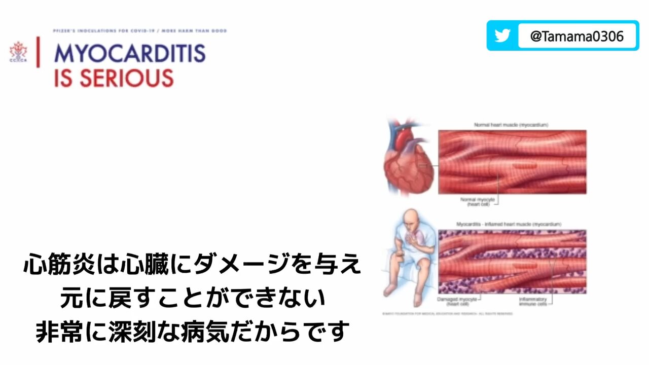 ファイザーの心筋炎を軽視した低レベルなエビデンス