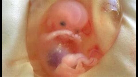 2 Parte, Testemunhos de Israel, Sobre Sangramento e Abortos Espontaneos depois das vacinas
