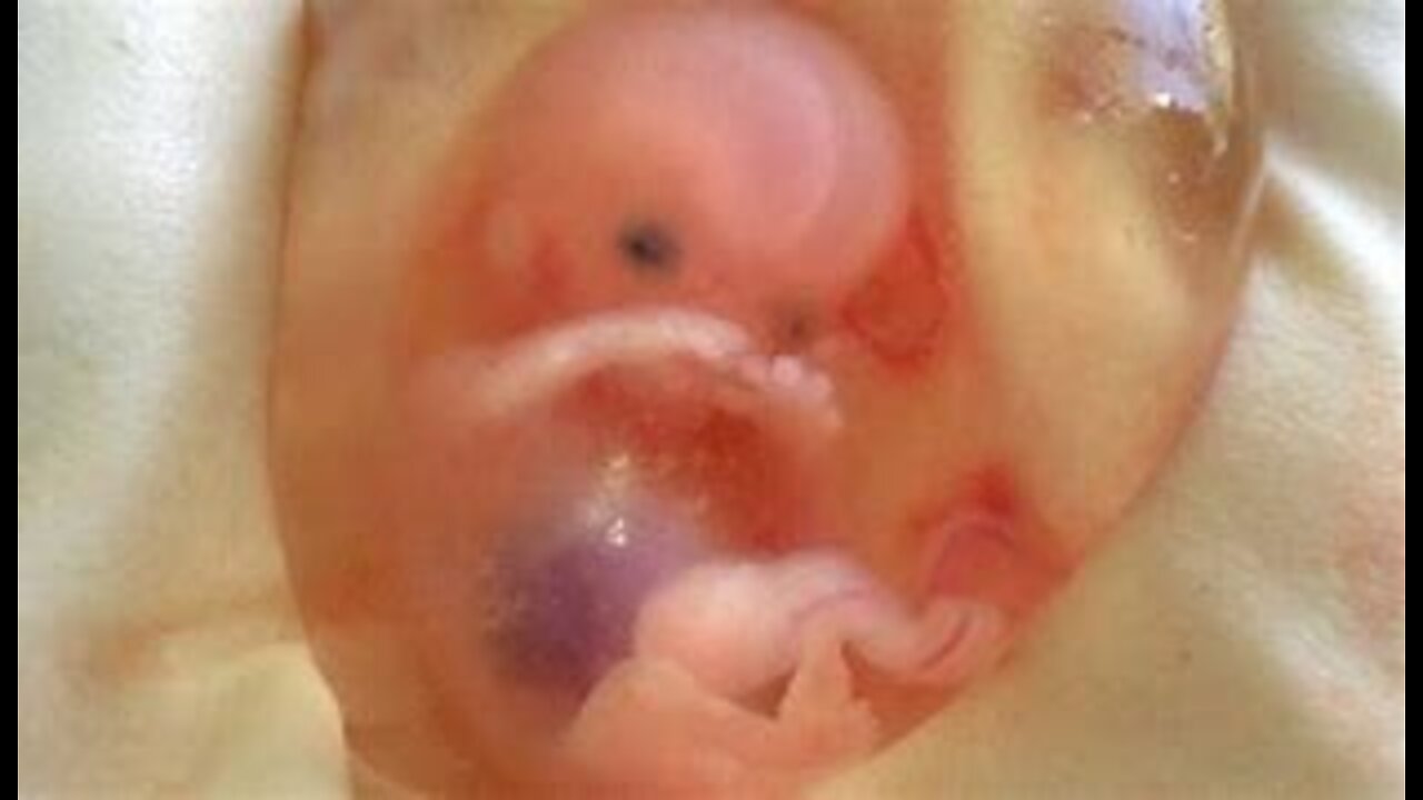 2 Parte, Testemunhos de Israel, Sobre Sangramento e Abortos Espontaneos depois das vacinas