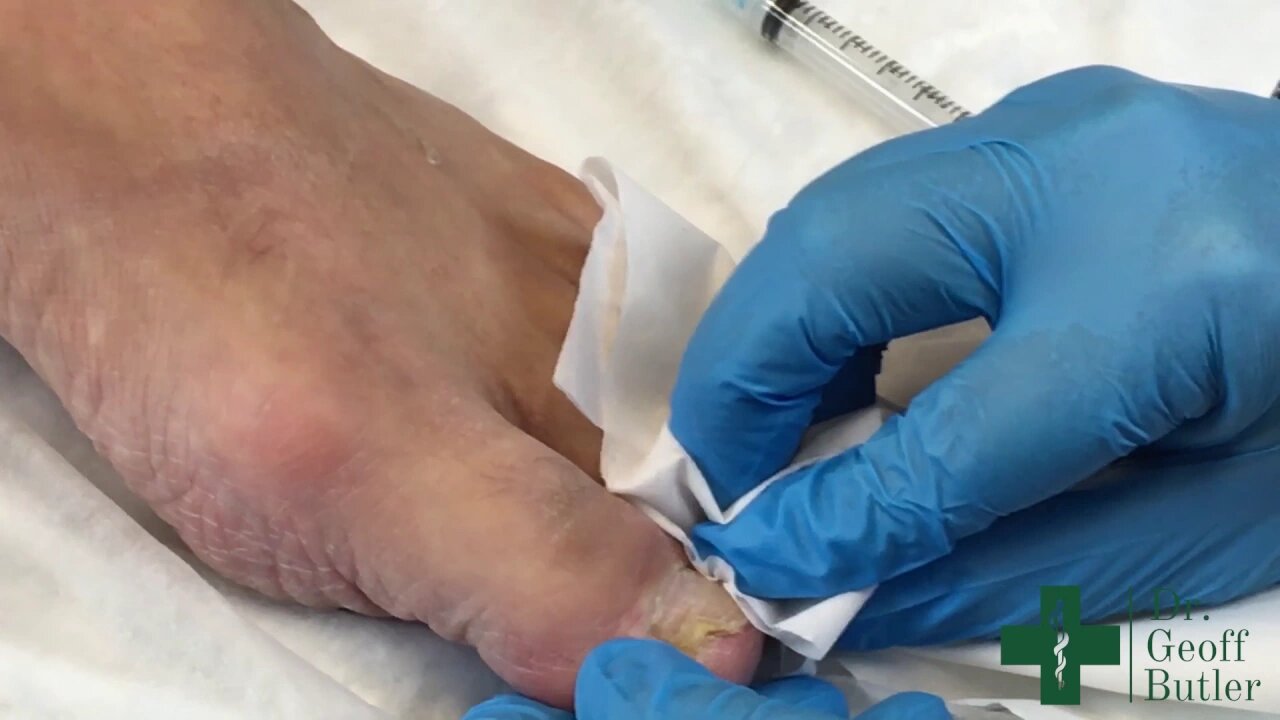 Drainage of a small paronychia