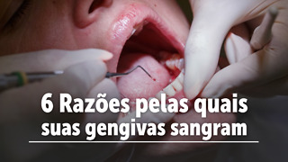 6 Razões Pelas Quais Suas Gengivas sangram