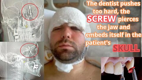 👨‍⚕️🛌 Dentist pushes too hard, screw pierces jaw and embeds in patient's skull