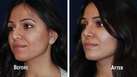 Dr. Robert Singer, MD FACS of Prime Plastic Surgery is a nationally acclaimed plastic surgeon