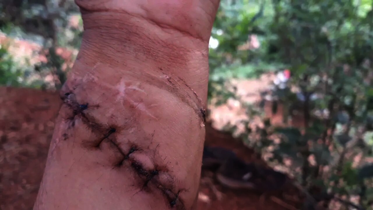 I had a big injury recently / Daily life vlog