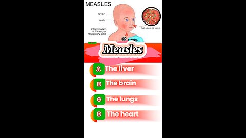 Measles MCQS: viral infection #antiviralmedication #emergencydrugs #pharmacology #pharmacologyexam