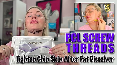 Tighten Chin Skin After Fat Dissolver with PCL Screw threads!AceCosm, Code Jessica10 saves you Money