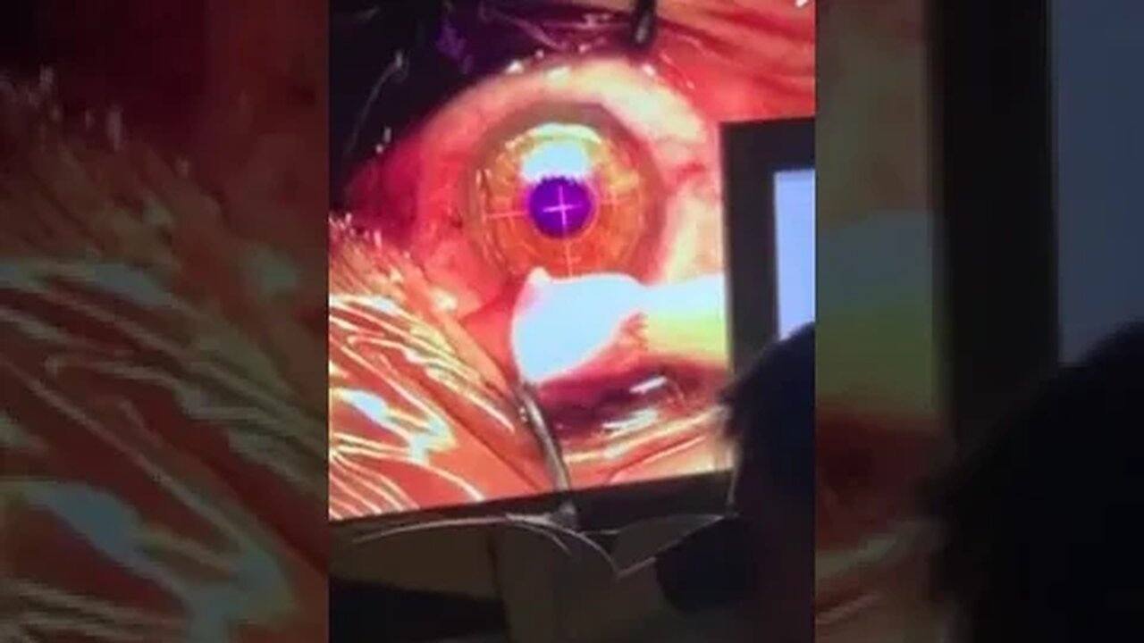 Lasik Eye surgery October of 2021