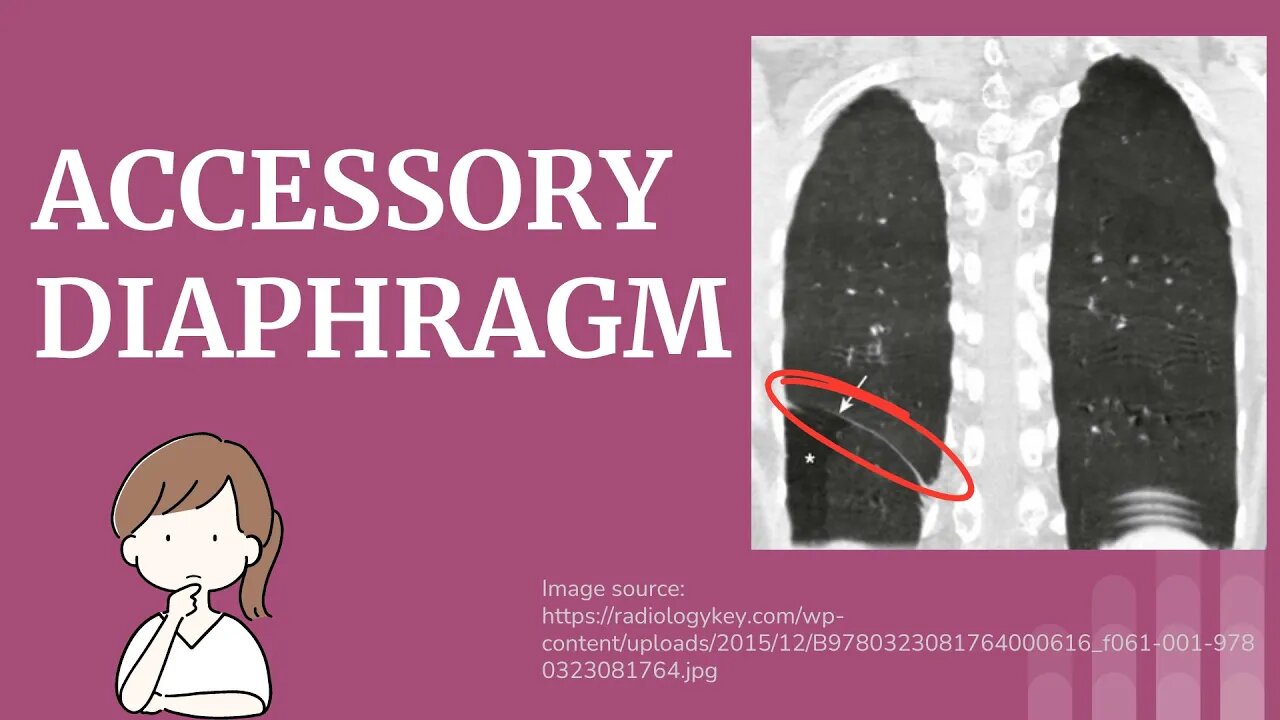 Accessory Diaphragm (Duplicated Diaphragm) Explained | Novice Medic