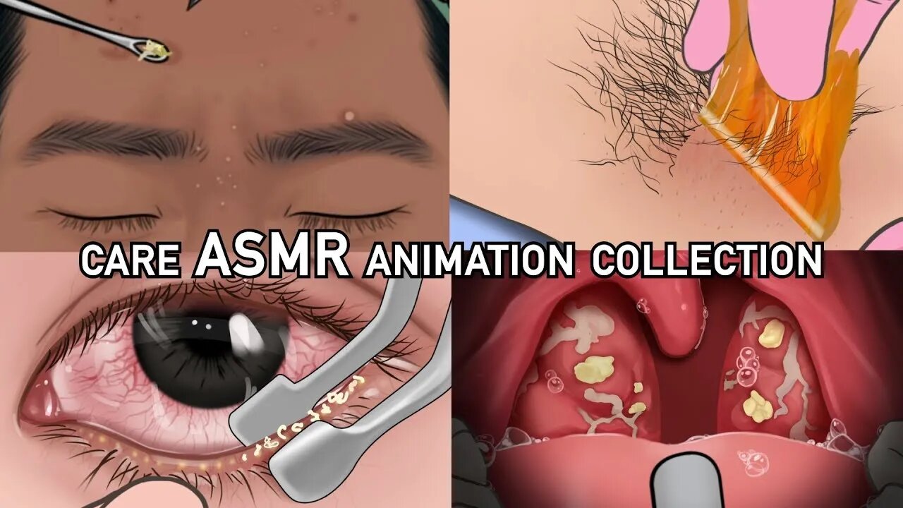 ASMR Eye discharge removal animation - Eyelid big acne extrusion and lashes lice deep cleaning