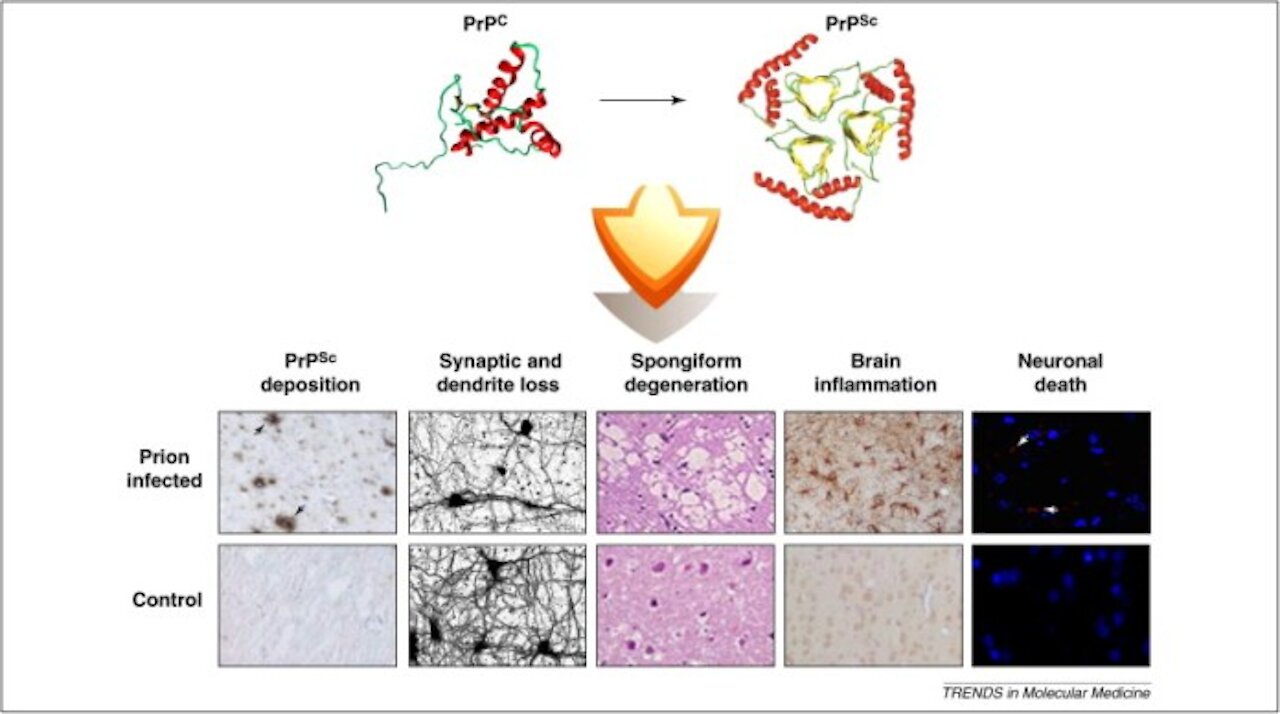 Shock! mRNA COVID-19Vax May Progressively Degenerate Your Brain From Prion Disease!