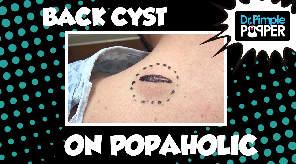 Back Cyst on a Popaholic... baby!