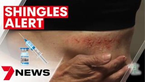It's the Shingles