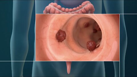 ¿Qué es el cáncer colorrectal?