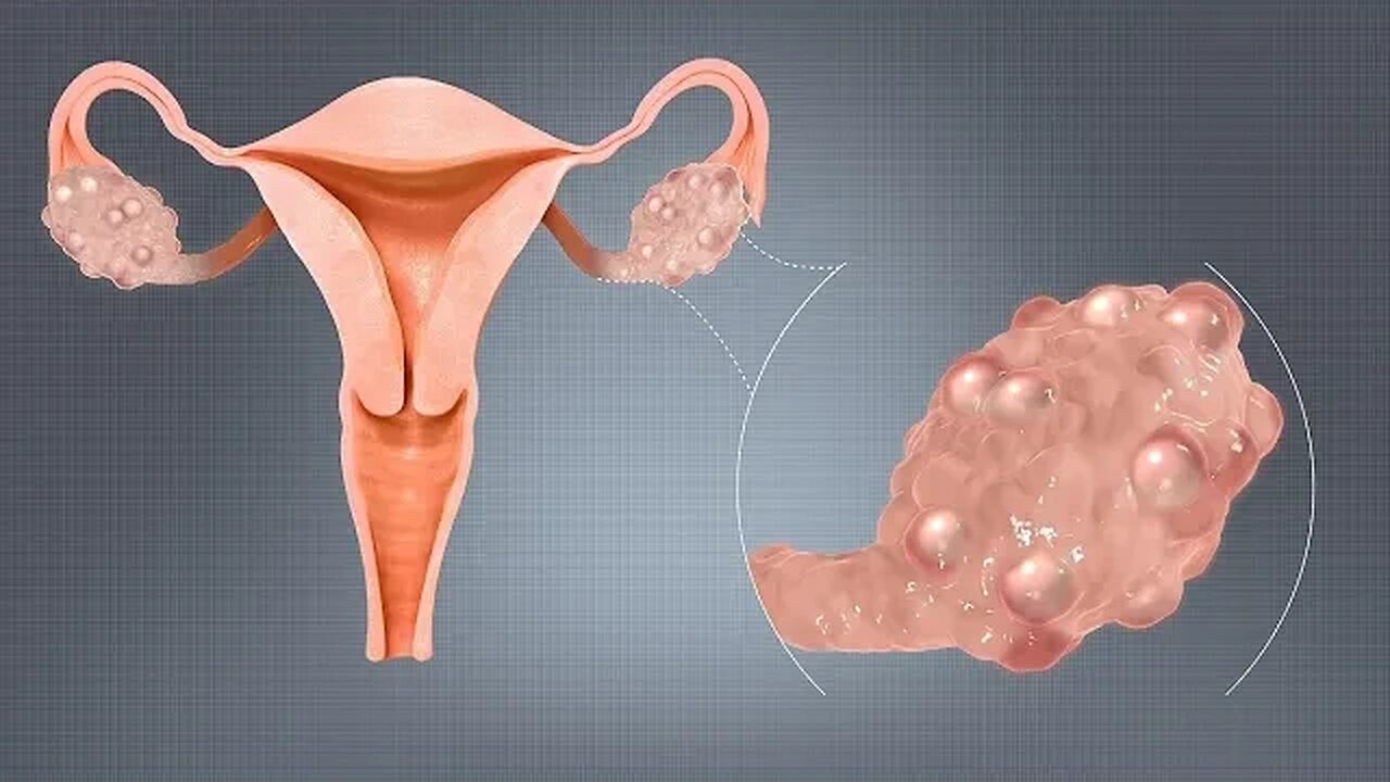 pcod kya hota haipcod problem solution in hindipcod ke lakshanpcod me pregnant kaise ho
