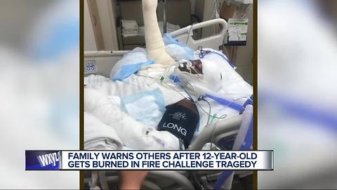 Metro Detroit girl injured after doing the Fire Challenge