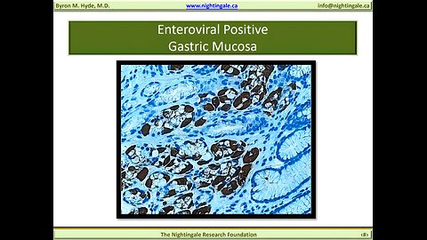 VP1 Enteroviral Gastric Biopsy (e.g. John Chia, MD) - Byron Hyde, MD