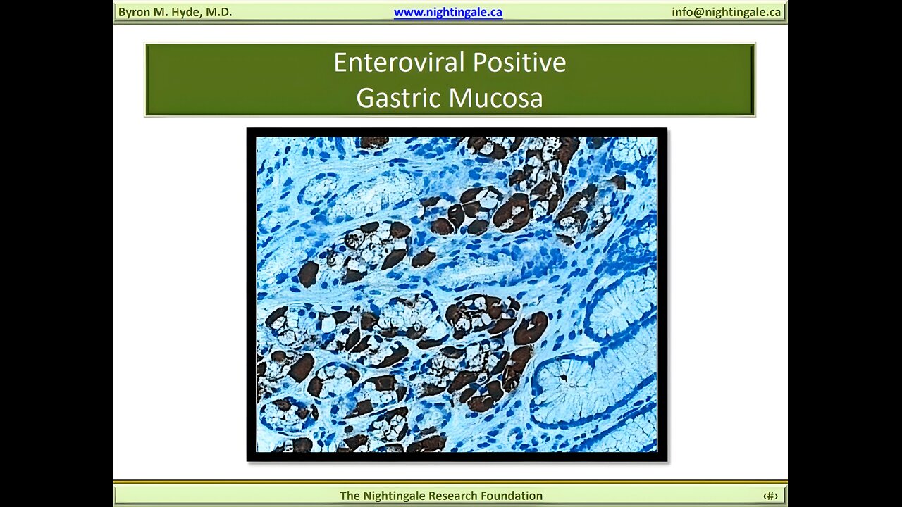 VP1 Enteroviral Gastric Biopsy (e.g. John Chia, MD) - Byron Hyde, MD
