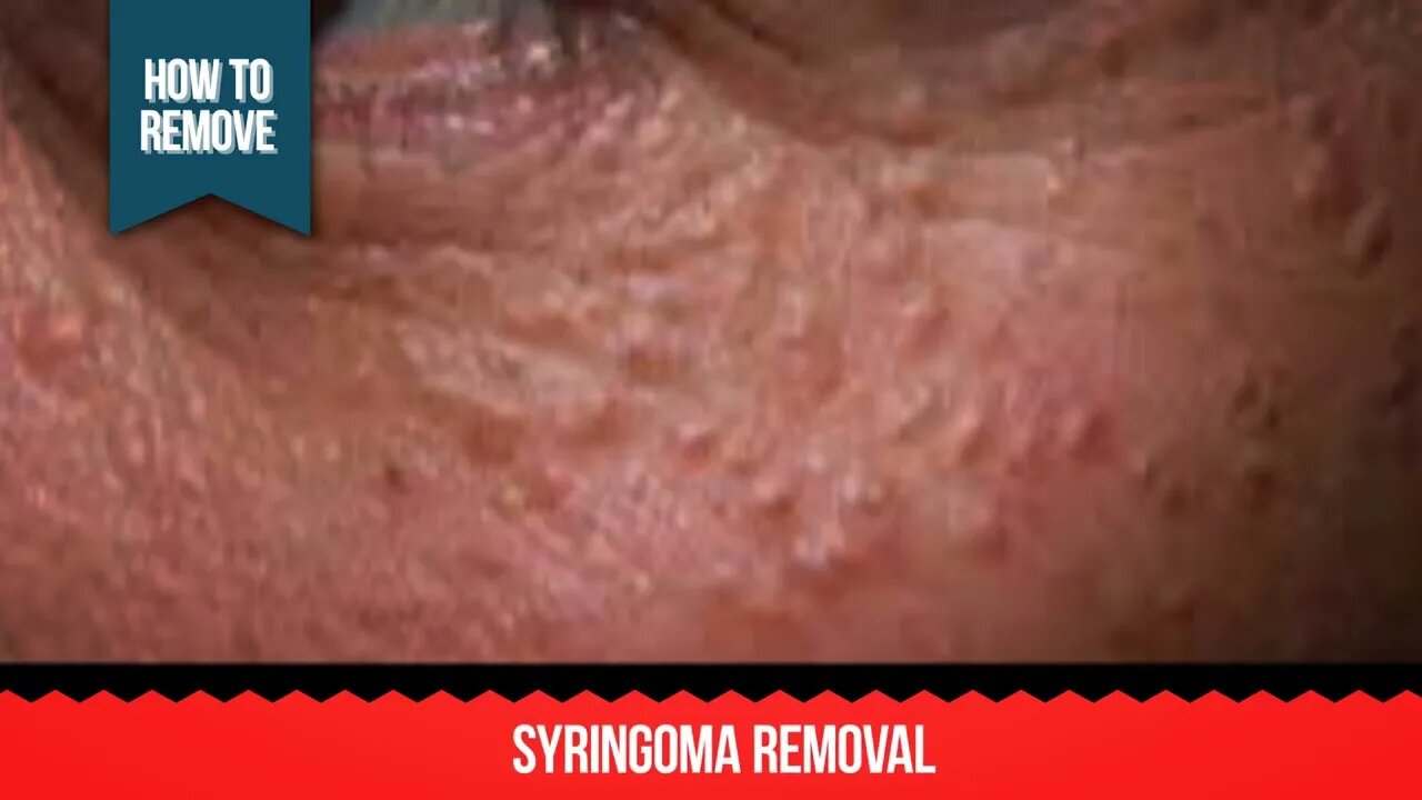 XanthRemover is the most effective, and the safest Professional Cosmetic peel, and its applications