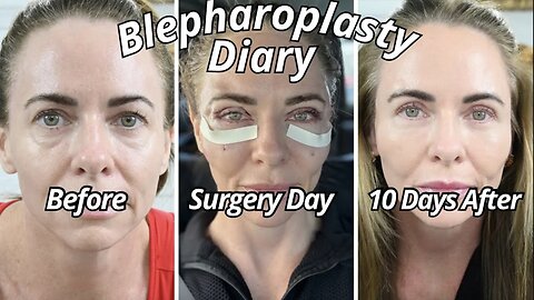 10 Day Progression of my Eyelid Lift Surgery