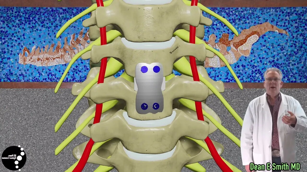 Anterior Cervical Decompression and Fusion