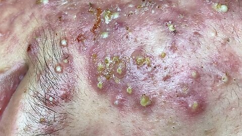 Big Cystic Acne Blackheads Extraction Blackheads & Milia, Whiteheads Removal Pimple Popping 7