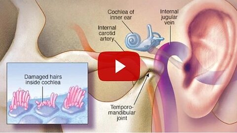 “IT WORKED TOO WELL” - TINNITUS CURE BANNED BY THE CCP MAKES A COMEBACK