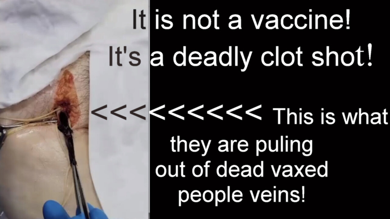 Proof it's not a vaccine, it's a DEADLY CLOT SHOT!