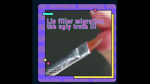 Lip filler migration UGLY TRUTH