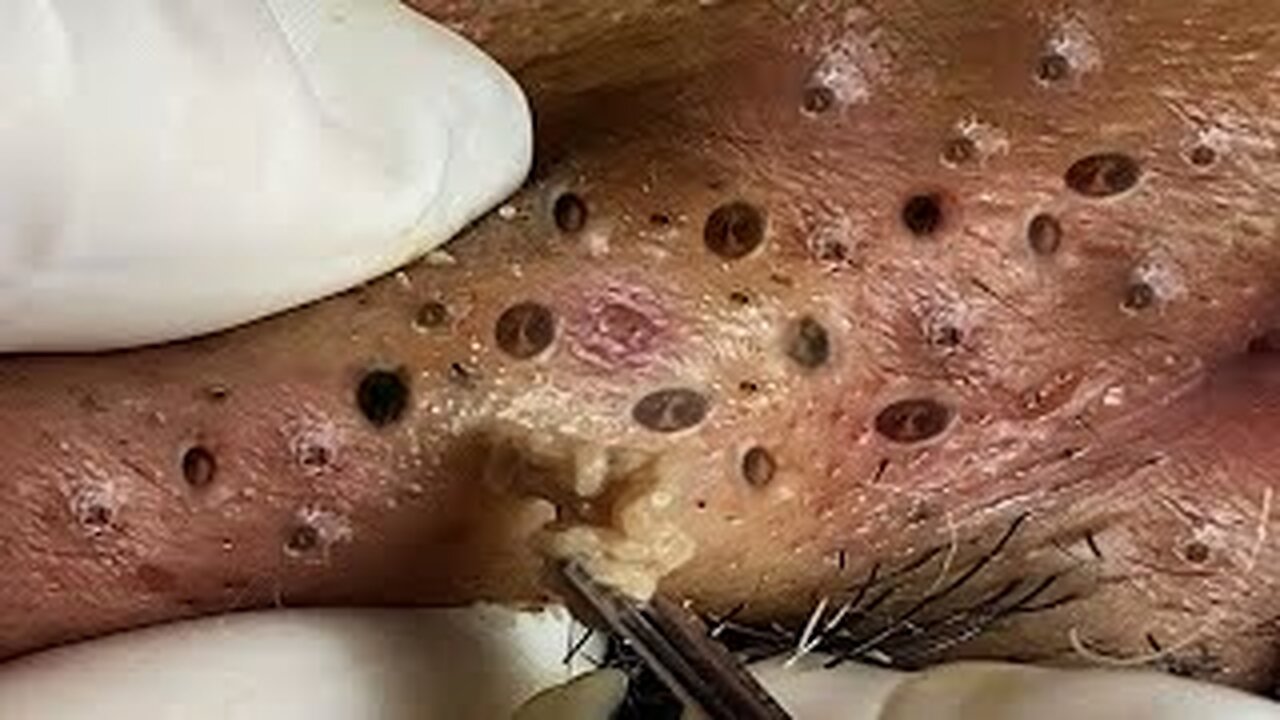 pimple popper, Satisfying blackheads removal and acne treatment 804