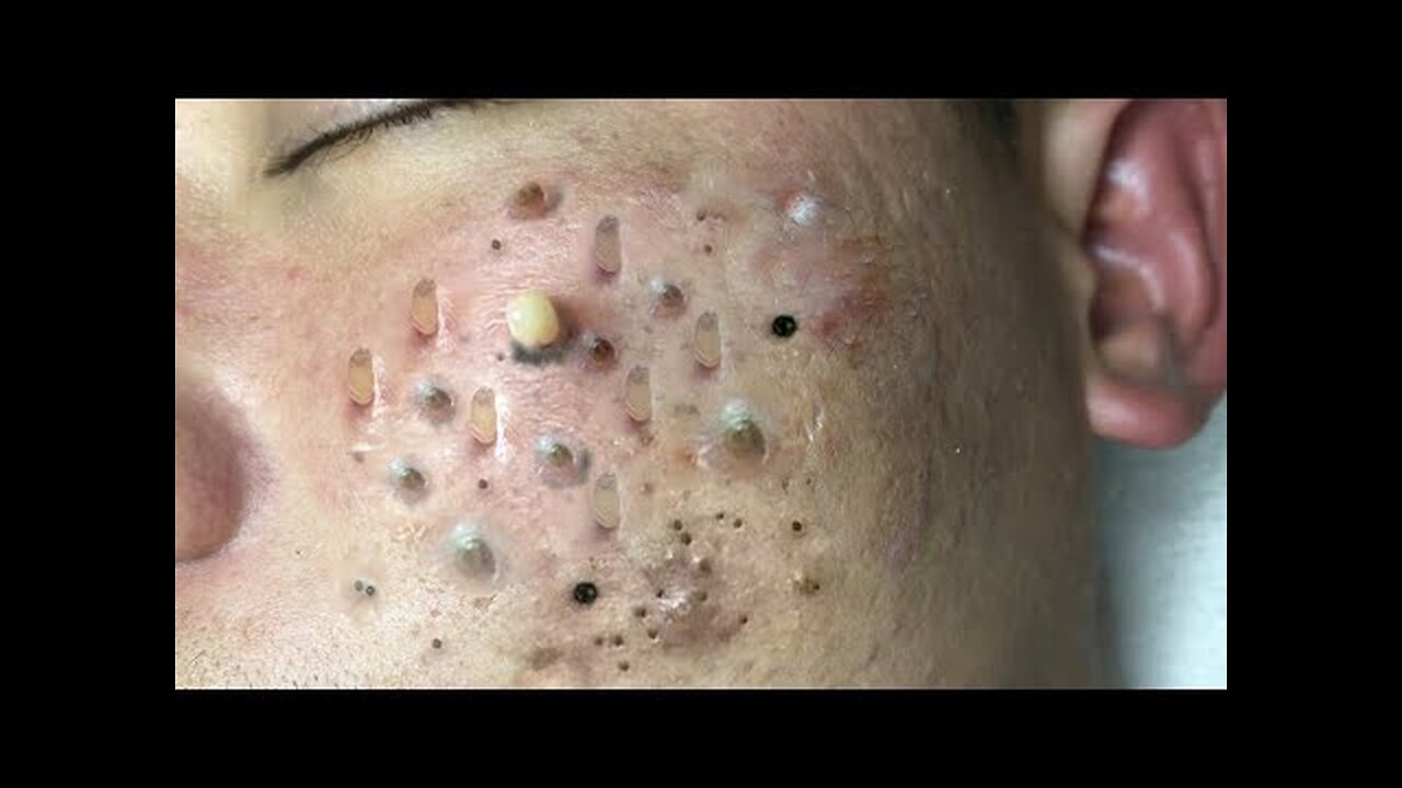 Satisfying blackhead removal, relaxing Pimple Popping #111
