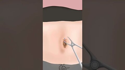 #@uttam6361 #infected Navel#asmr #funny #video #funnyvideo #anime #shortsvideo #slimeasmr