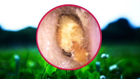 Ear Wax Removal With Clam Relaxing Music #11