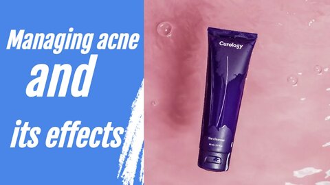 Managing acne and its effects