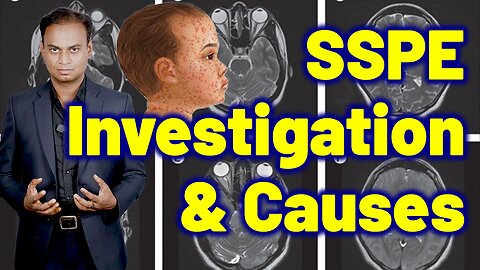 Investigations Causes Risk factors SSPE, Subacute Sclerosing Panencephalitis | Treatment Cure Relief