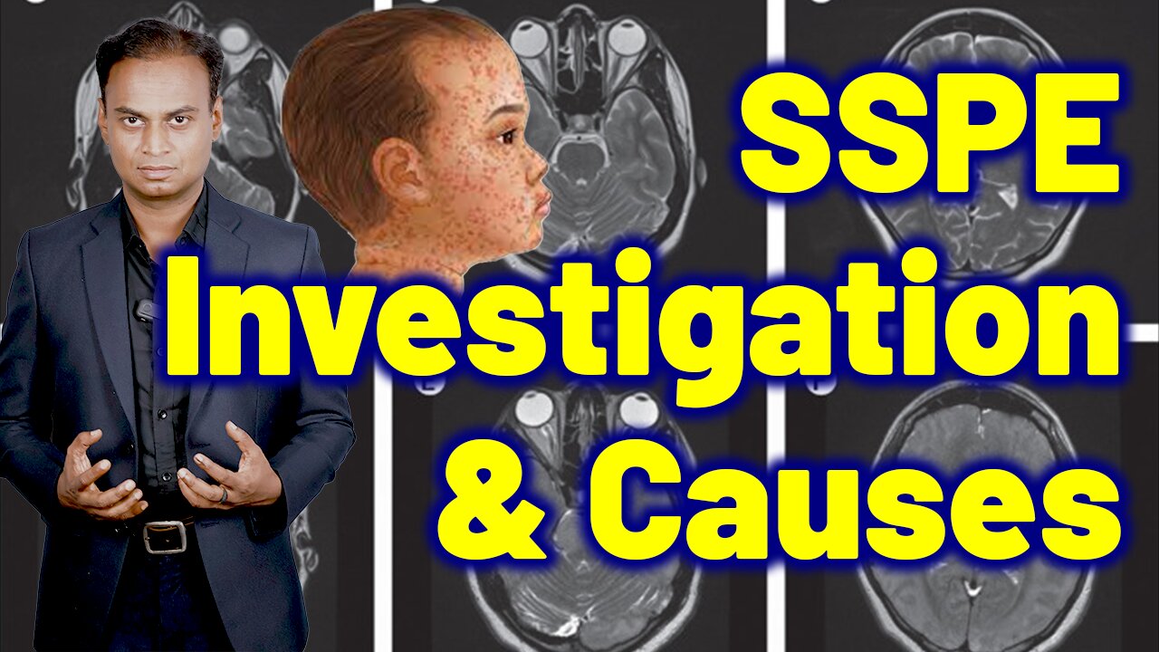 Investigations Causes Risk factors SSPE, Subacute Sclerosing Panencephalitis | Treatment Cure Relief