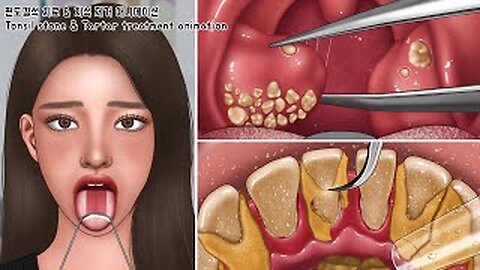 SATISFYING I ASMR Tartar & Toensil Removal