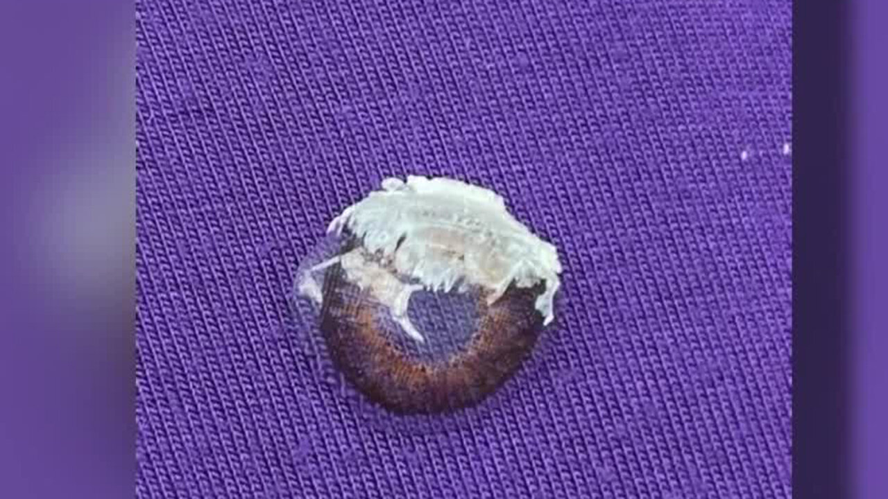 Woman mistakes nail glue for eye drops