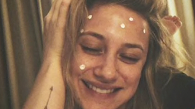 Lilie Rainhart Opens Up About Her Struggles With Skin Disease
